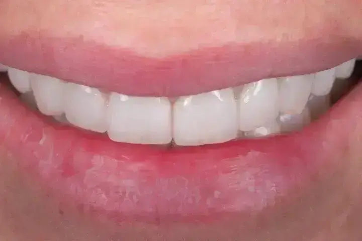 Поставяне на коронка на зъб