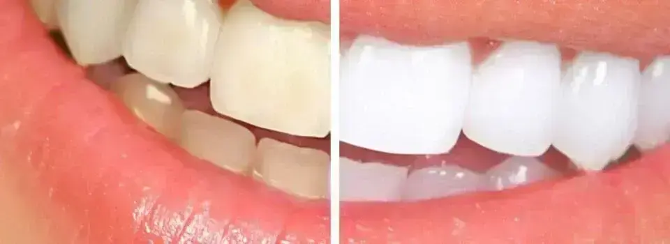 избелване на зъби