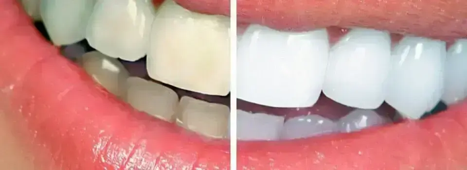 избелване на зъби