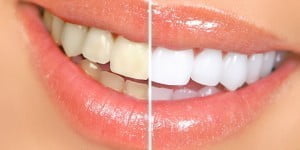Избелване на зъби